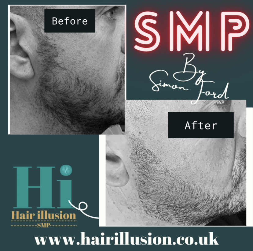 Beard micro pigmentation London